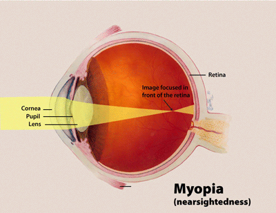 Diagram of Myopia (Nearsightedness)
